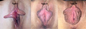 Classification de l'hypertophie labiale