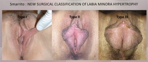 Les différentes formes de malformation des petites lèvres du sexe féminin