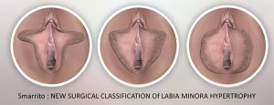 Classification des hypertrophies labiales avant nymphoplastie